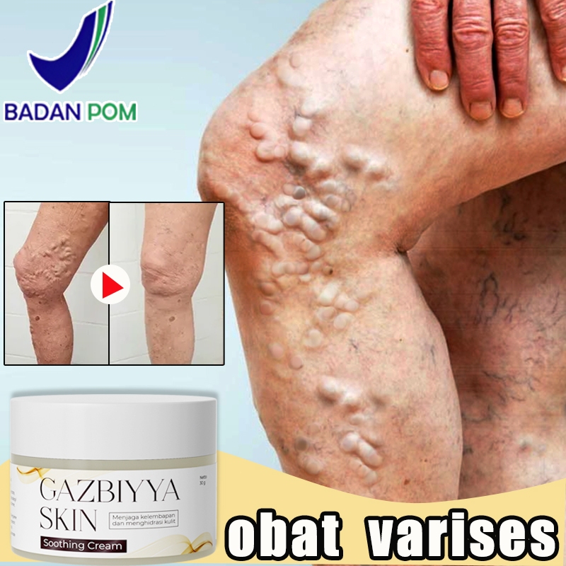 Obat varises Salep varises Cream varises paling ampuh original  Varicose veins cream 30g salep varis