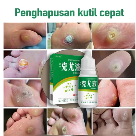 Penghilang Kutil Salep Penghilang Kutil Salep Kalus Kaki 10g Tahi Lalat Obat Penghilang Kutil Di Waj