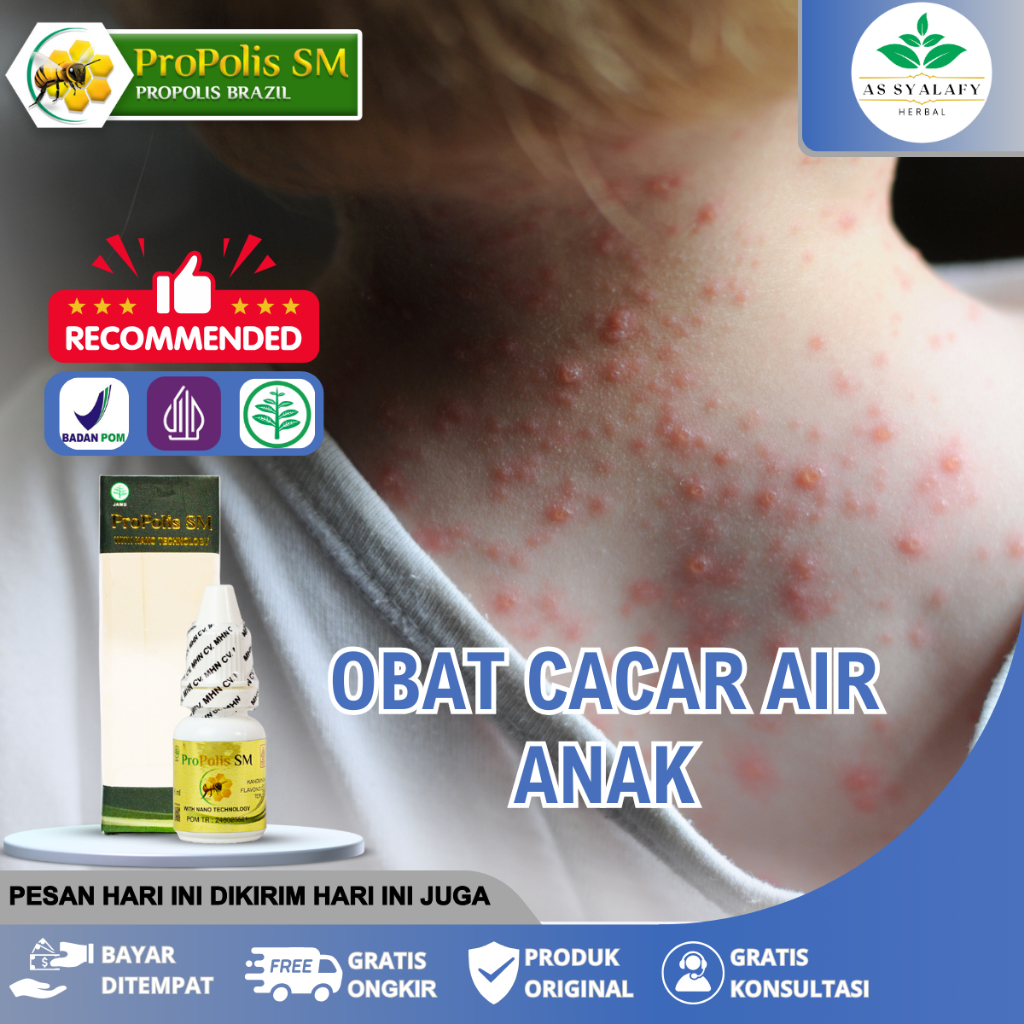 Obat Cacar Air Bintik Merah Gatal Gatal Panas Kulit Melepuh Obat Cacar Air Anak & Dewasa Yang Aman