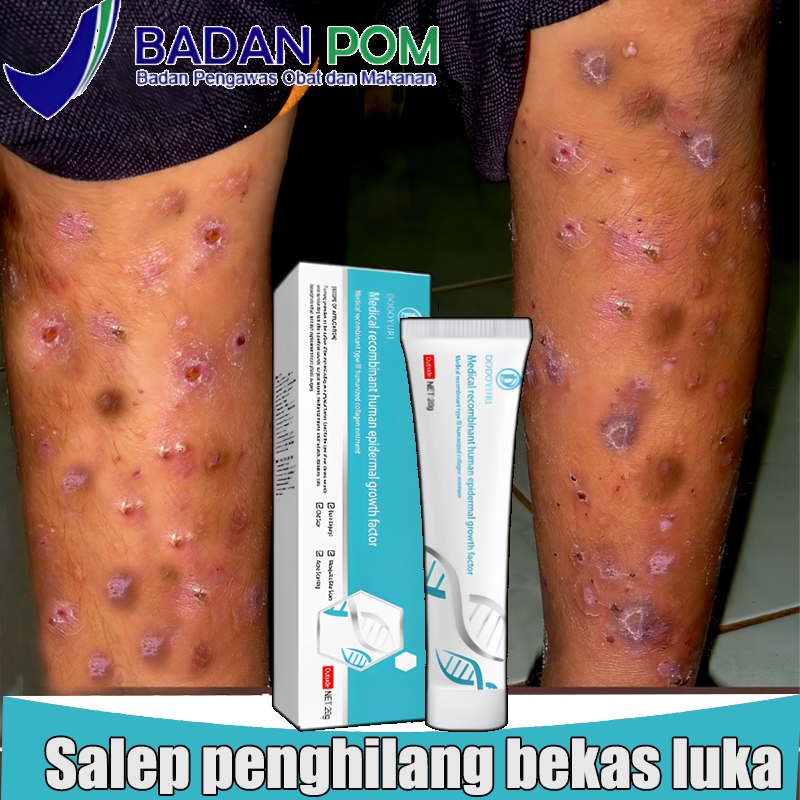 Obat penghilang bekas luka Salep penghilang bekas luka Salep penghilang bekas luka hitam Penghilang 