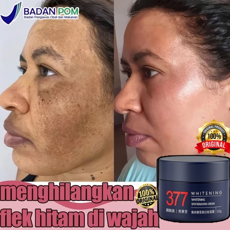Cream Flek Hitam Membandel Cream Penghilang Flek Hitam 377 Krim Wajah Pencerah Anti Bintik Moisturiz
