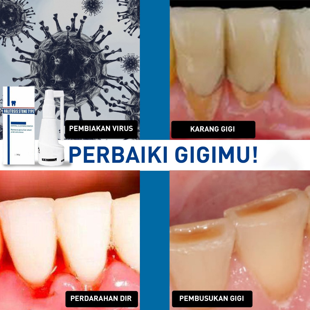 Pembersih karang gigi Alat pembersih karang gigi Perontok karang gigi paling ampuh Karang gigi peron