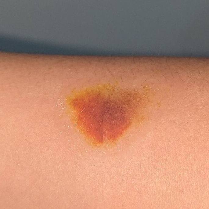 [Healing Bruise 13] TATO TEMPORER LEBAM | TATO TEMPORER MEMAR | BRUISE TATTOO | LUKA BENGKAK PALSU |
