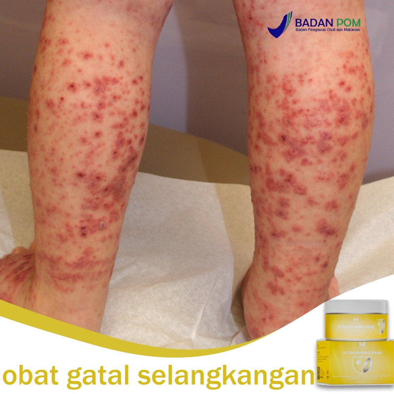 Salep gatal china paling ampuh obat gatal selangkangan salep eksim paling ampuh 20g salep gatal eksi