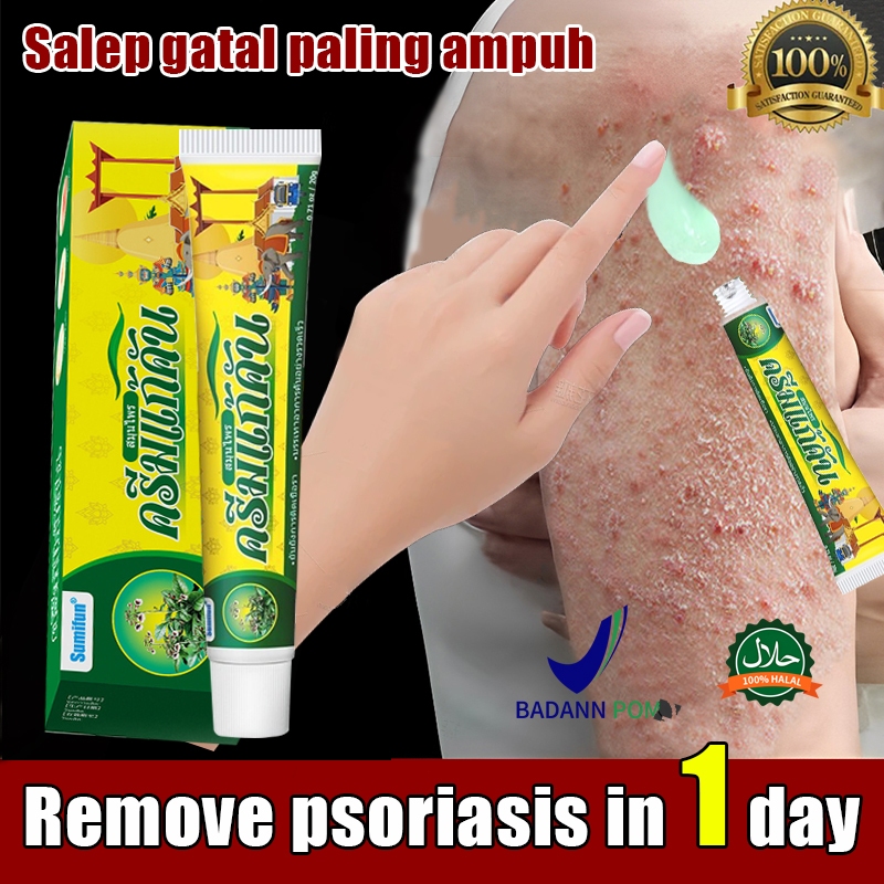 Salep gatal paling ampuh 20g obat gatal obat eksim salep gatal selangkangan Salep Alergi Kulit Gatal