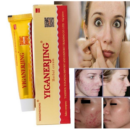 Yiganerjing Salep Obat Kulit Gatal Original Ampuh