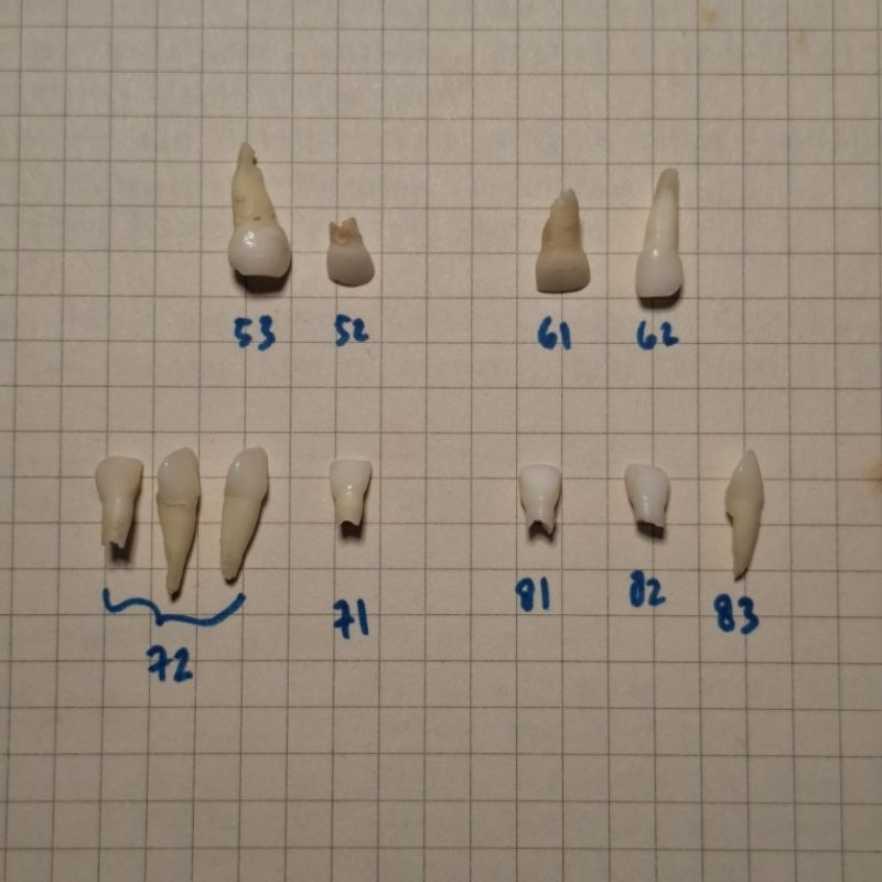 Gigi Sulung Anterior Asli 52 53 61 62 71 72 81 82 83 | Gigi Sulung Insisivus Caninus Asli Praktikum