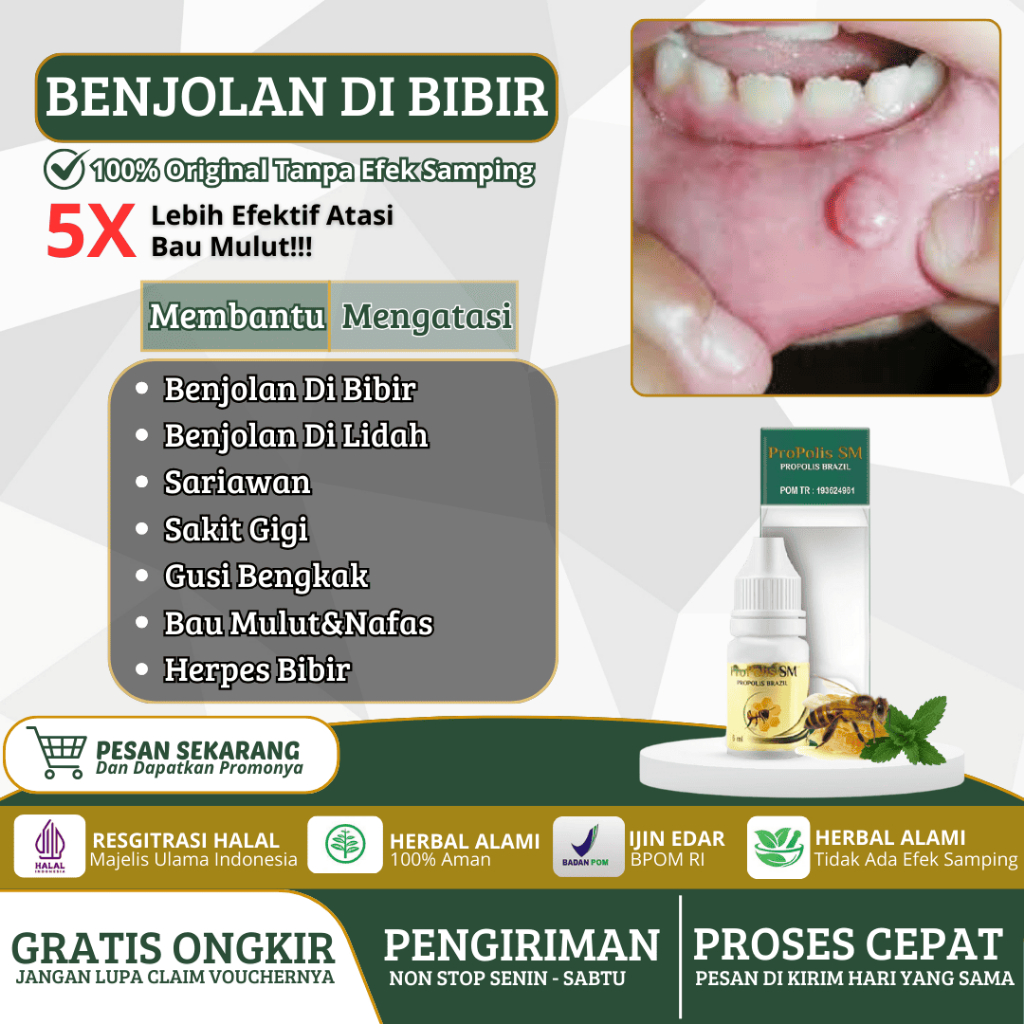Obat Benjolan Di Bibir Mulut Lidah Gusi Tumor Jinak Propolis Sm 100% Original Tanpa Efek Samping