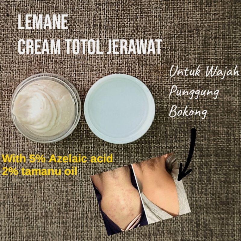 Cream Obat Jerawat Totol Punggung Bokong Ampuh Cepat