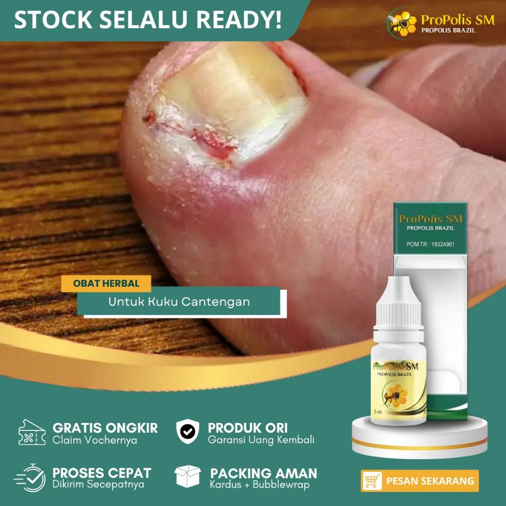 Obat Cantengan Pada Jempol Kaki, Obat Cantengan Jari Tangan, Obat Cantengan Kuku Jempol Kaki