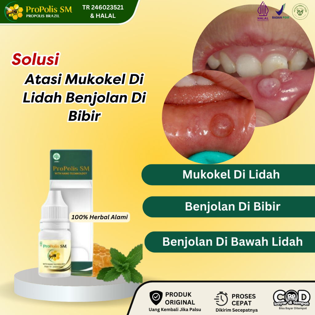 Obat Mukokel, Obat Benjolan Di Lidah, Obat Mulut Mukokel, Obat Benjolan Di Bawah Lidah, Obat Lidah G