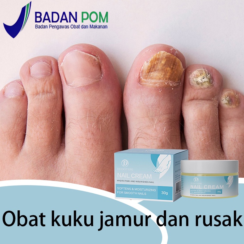 BPOM Obat jamur kuku Obat kuku jamur dan rusak vitamin kuku rusak 3g Obat kuku cantengan jempol kaki