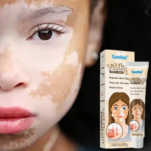 Salep Vitiligo Obat Vitiligo Obat Penghilang Vitiligo Cream Vitiligo Bintik Putih Krim Vitiligo Sale