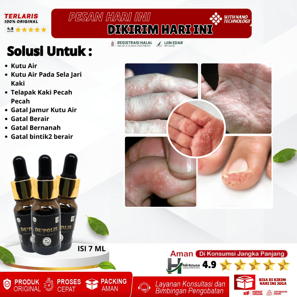 Obat Kutu Air, Obat Kutu Air Pada Sela Jari Kaki, Obat Telapak Kaki Pecah Pecah, Obat Gatal Jamur Ku