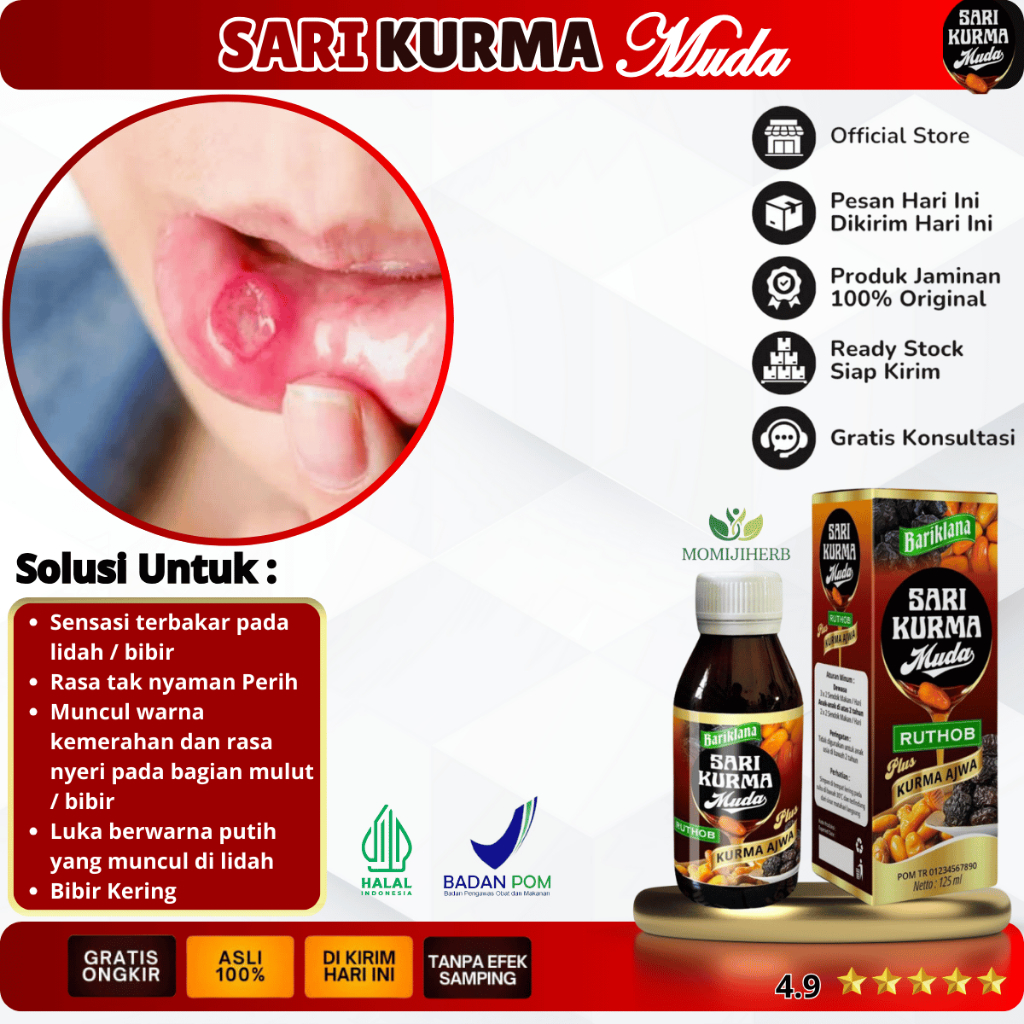 Obat Sariawan, Sariawan Celiac, Sariawan Tropikal, Sariawan Nontropikal, Sariawan Kecil, Sariawan Be