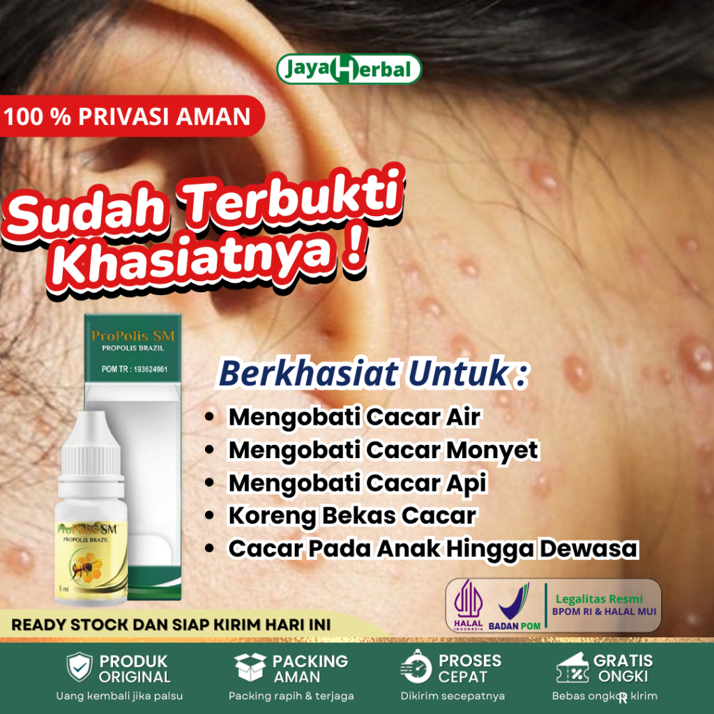 Obat Cacar Air, Obat Cacar Monyet Monkeypox, Obat Cacar Api, Obat Penghilang Bekas Cacar, Obat herpe