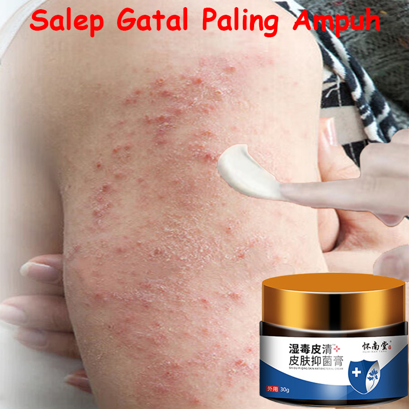 Salep Gatal Paling Ampuh Anti Jamur Gatal Gatal Seluruh Badan Obat Gatal Kulit Salep Eksim Gatal Sal