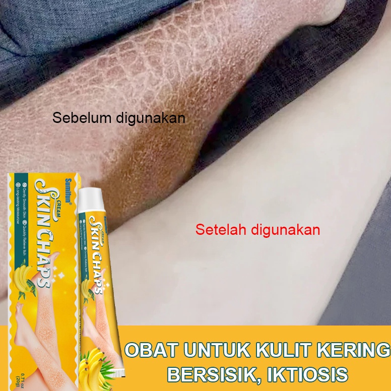 KODE D9O5 lktiosis kulit Salep eksim iktiosis Obat jamur kulit Salep kulit Obat gatal kulit Krim kak