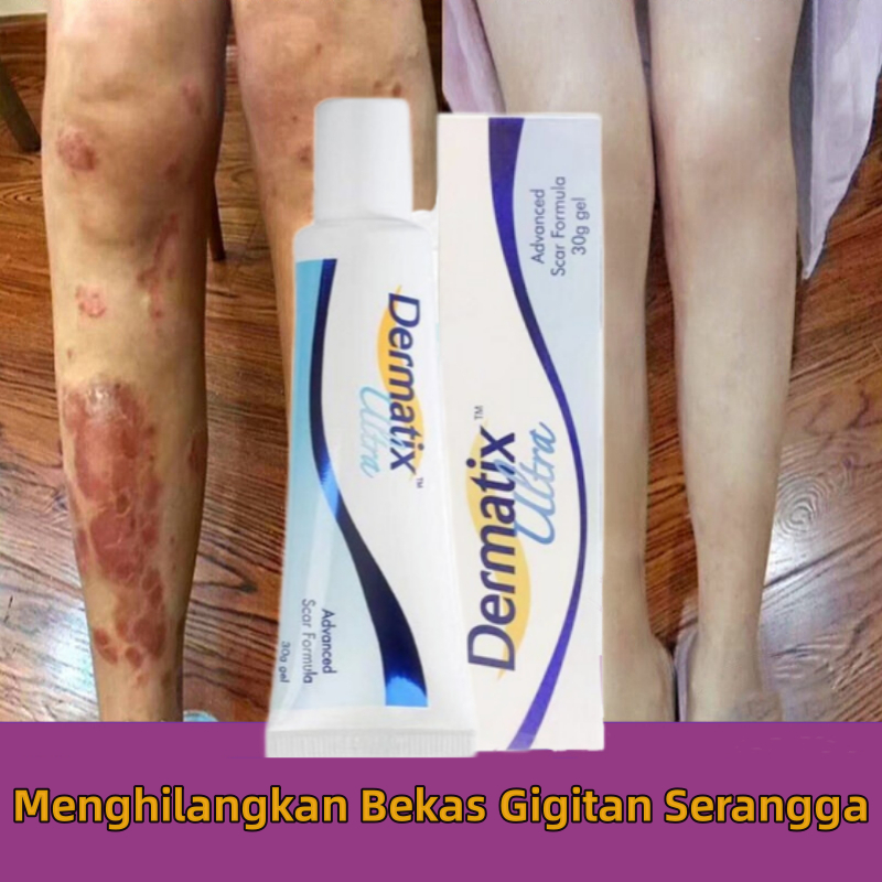 Dermatix Ultra Cream 15g Salep Penghilang Bekas Luka Menghilangkan bekas luka hitam, bekas gigitan s