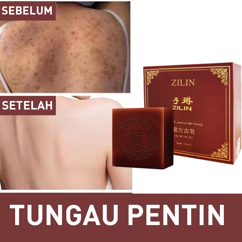 Sabun Penghilang Bekas Luka Menghilangkan Bekas Luka Keropeng Hitam Menghilangkan Bekas Luka Kaki Me