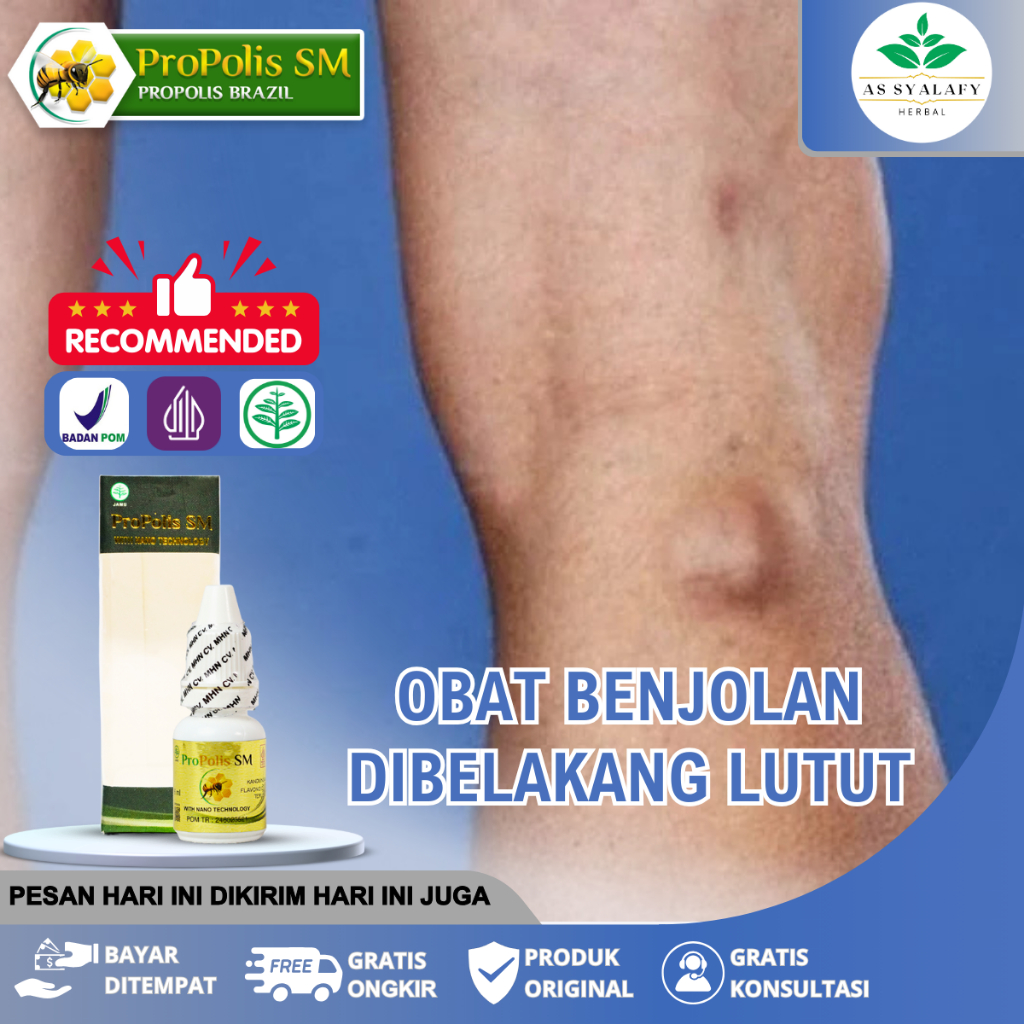 Obat Benjolan Lutut, Kista Baker, Benjolan Belakang Lutut Terlaris Propolis SM 100% Asli Di Surabaya