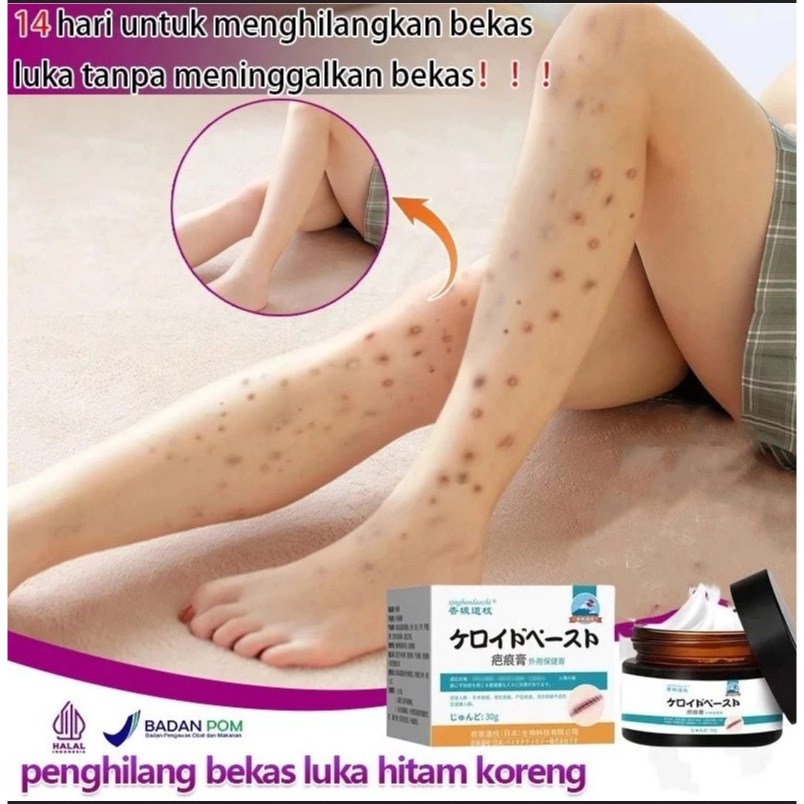 CREAM PENGHILANG BEKAS LUKA LAMA MENGHITAM KORENG KULIT KAKI TANGAN TUBUH WAJAH SALEP OBAT PENGHILAN