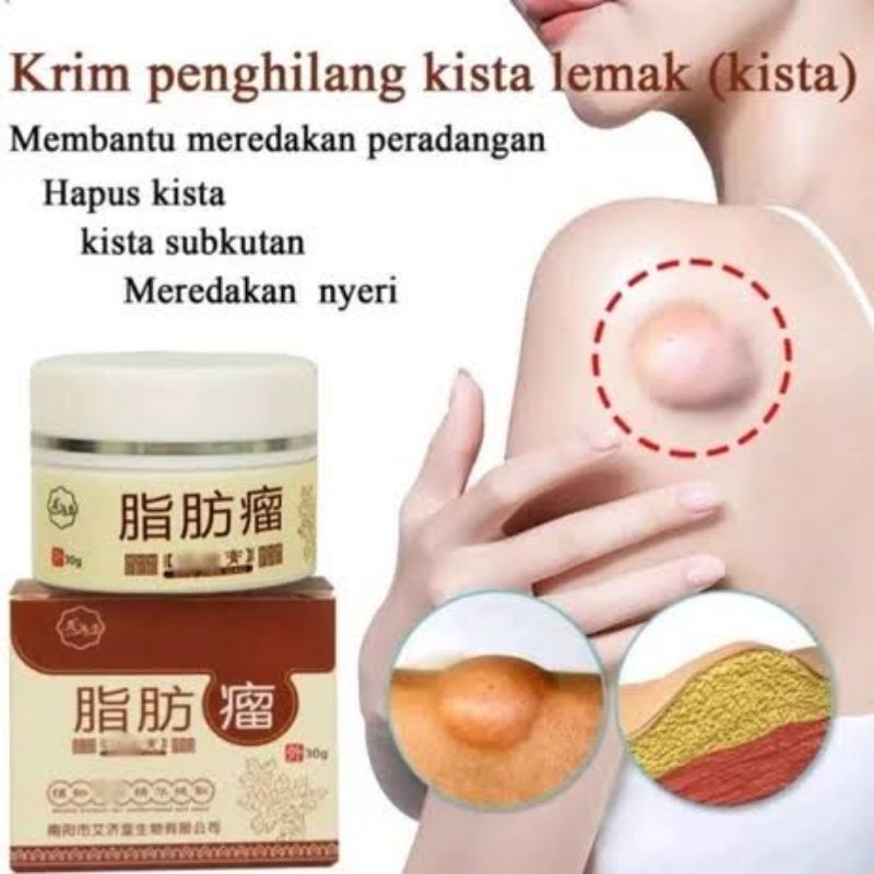 salep cream lipoma salep cream benjolan lipoma