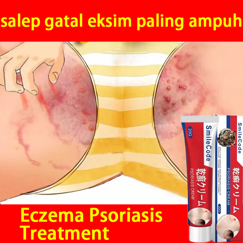 （BPOM）salep gatal eksim paling ampuh salep gatel salep eksim salep gatal kulit yang ampuh salep eksi