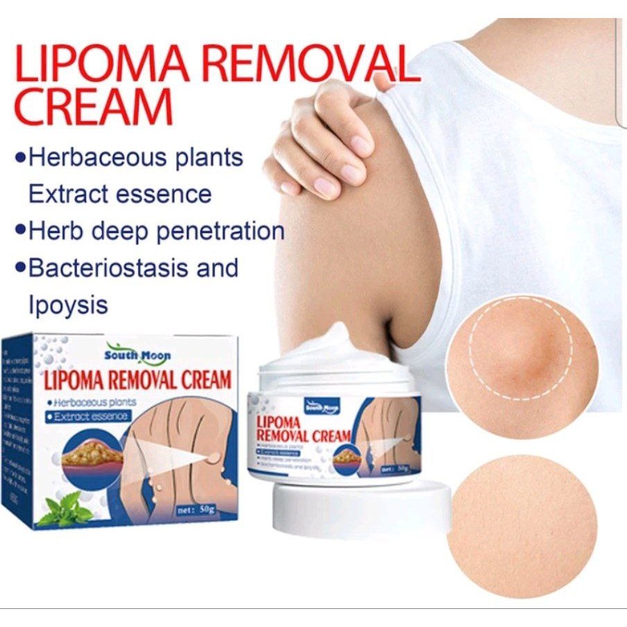 lipoma removal cream / lipoma remover krim lipoma