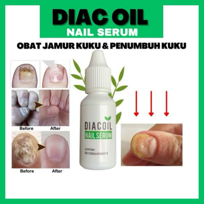 Diacoil Nail Serum Obat Jamur Kuku & Penumbuh - Kuku centengan rusak bengkak penghilang jamur kuku