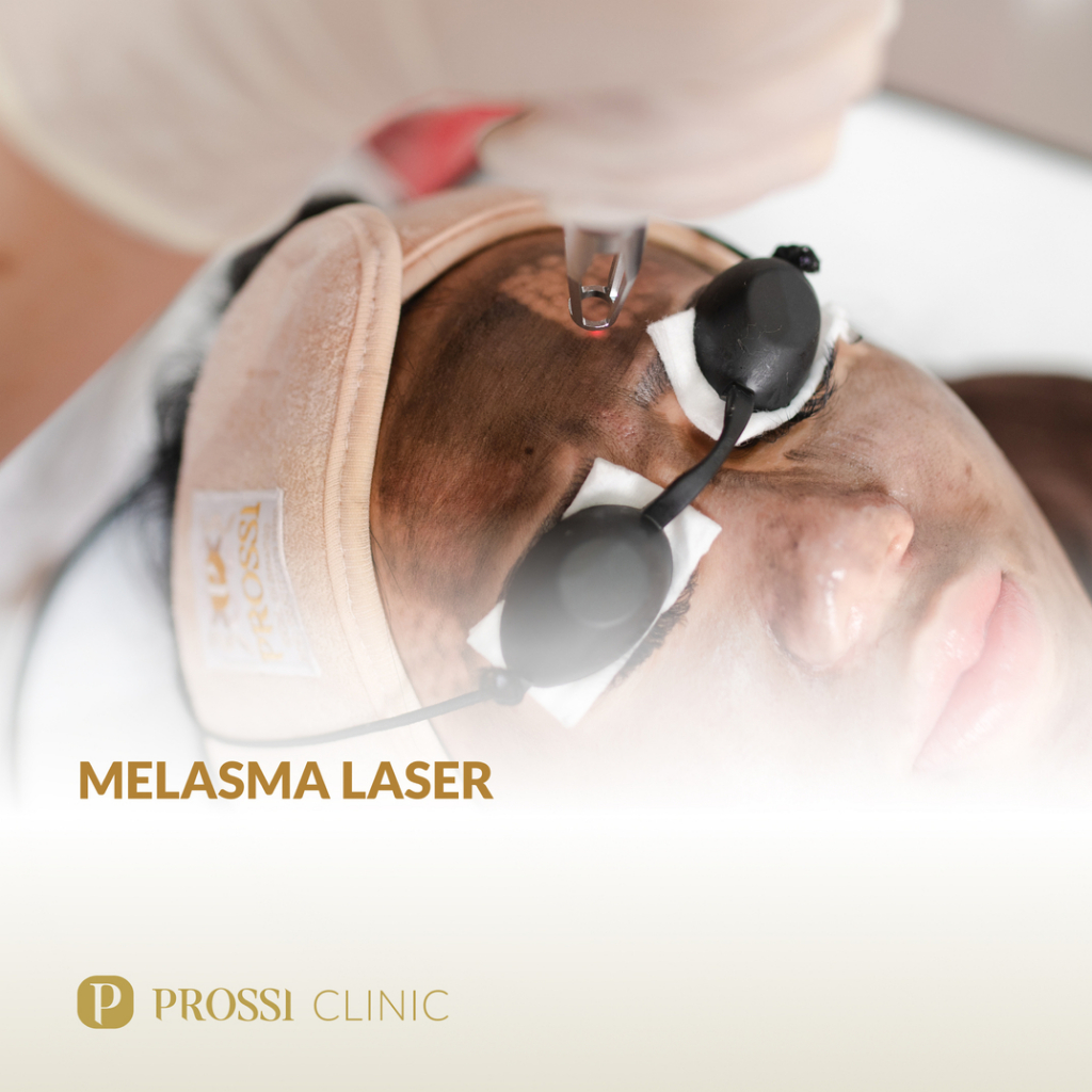 Melasma Laser -Flek Hitam, Melasma, Wajah Kusam, Mencerahkan Wajah- Prossi Clinic