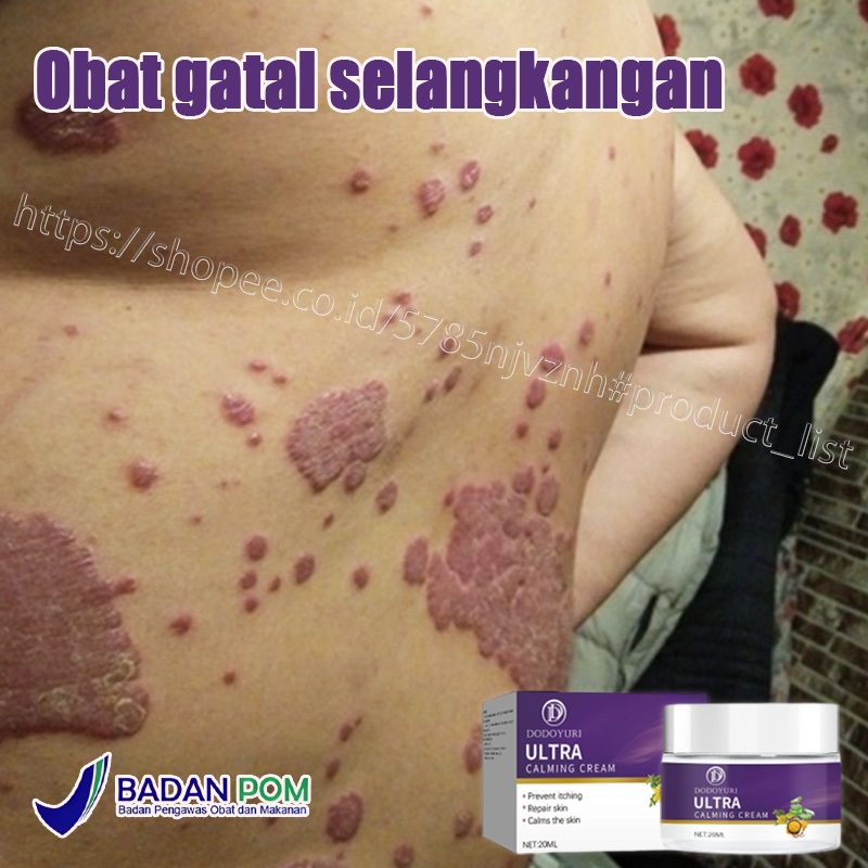 【100%Ori】Salep gatal paling ampuh obat gatal selangkangan obat gatal paling ampuh 20g Salep gatal se