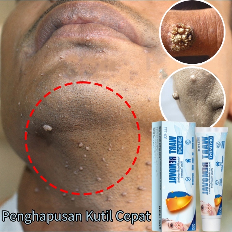 Salep kutil paling ampuh Penghilang kutil Skin tag remover Penghilang kutil di wajah Wart removal Sa