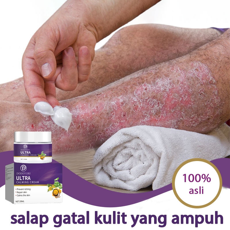Obat gatal salep gatal selangkangan salep gatal china paling ampuh salep eksim kering paling ampuh 2