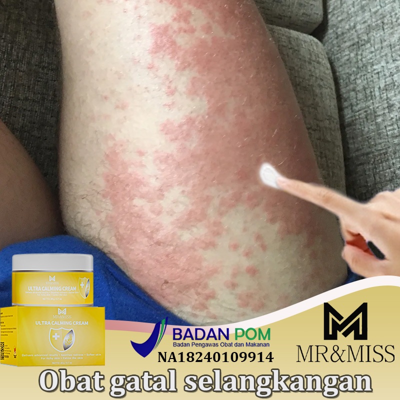 【BPOM】Obat gatal selangkangan Salep gatal selangkangan Salep gatal china paling ampuh Obat gatal gat