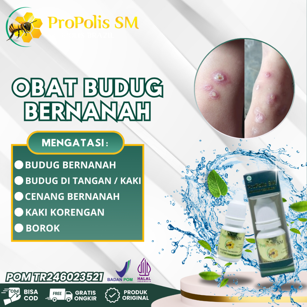 Obat Salep Budug, Kulit Gatal Cenang Bernanah, Borok di Kaki, Obat Koreng, Koreng di Kaki, Obat Budu
