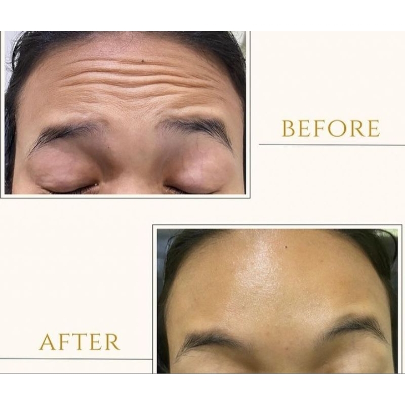 Botox Korea Vem Skin Klinik (100 dan 200 unit)