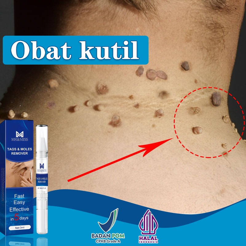 Obat penghilang tahi lalat obat penghilang kutil obat kutil paling ampuh 100%Original obat kutil kel