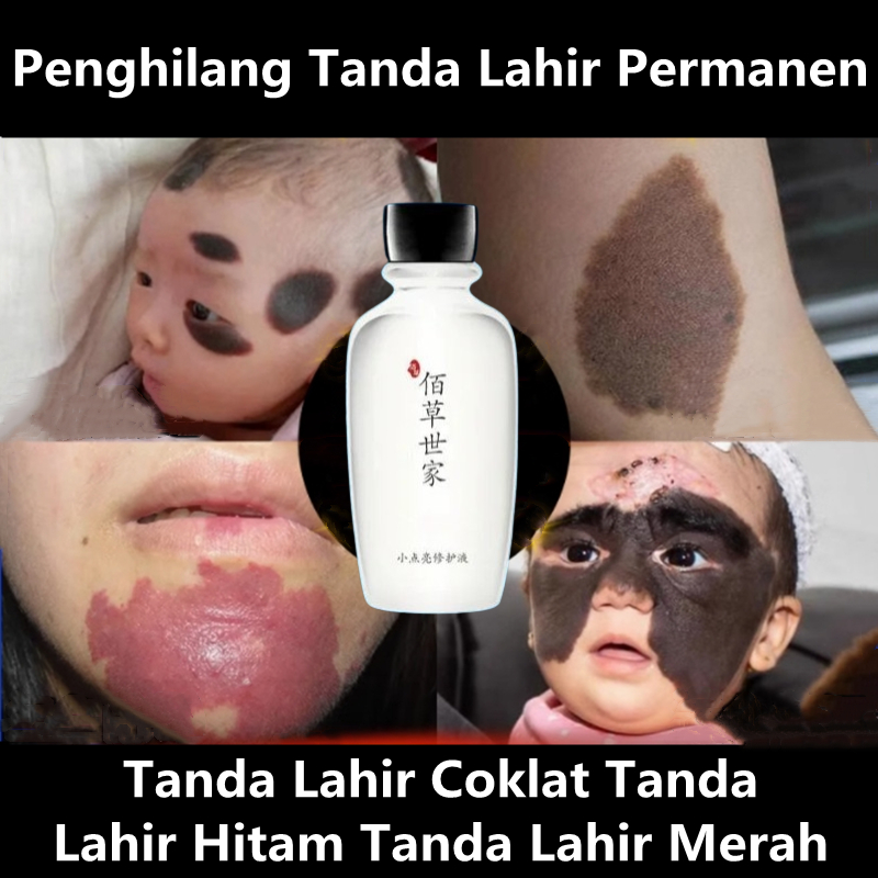 Penghilang Tanda Lahir Bayi Permanen Tanda Lahir Coklat Tanda Lahir Hitam Tanda Lahir Merah Obat Pen
