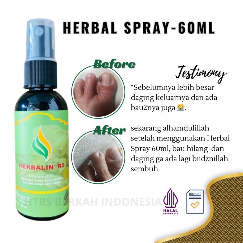 Minyak Obat Luka Diabetes Herbalin RS Spray - Minyak Ampuh - Membersihkan Bekas Luka Operasi,Luka Ba
