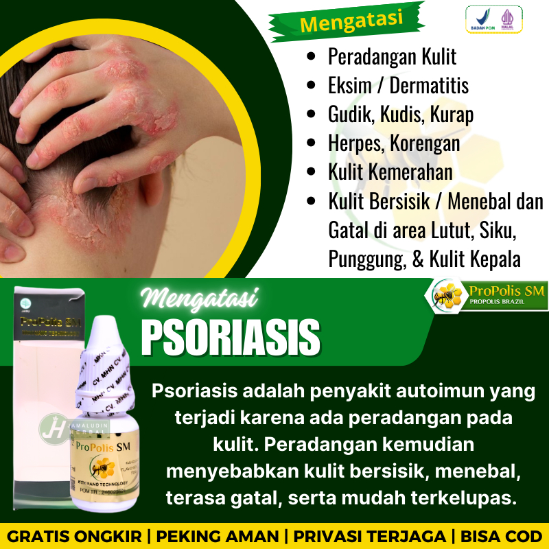 Salep Oles Borok Di Kepala Akibat Penyakit Kulit Psoriasis - Obat Ketombe Parah Berkerak dan Bersisi