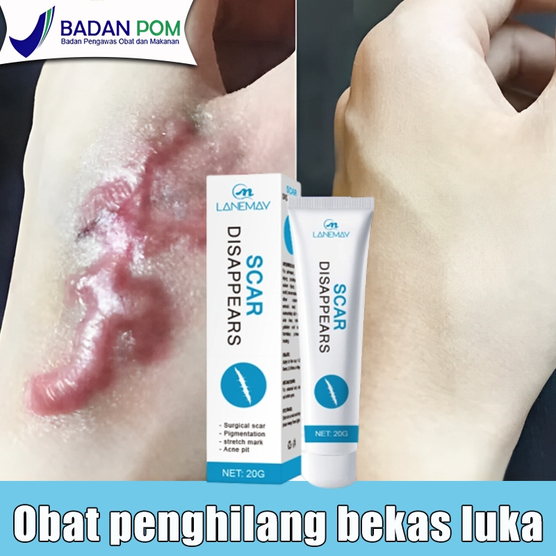 Salep penghilang bekas luka Obat penghilang bekas luka Penghilang bekas luka hitam koreng Menghilang