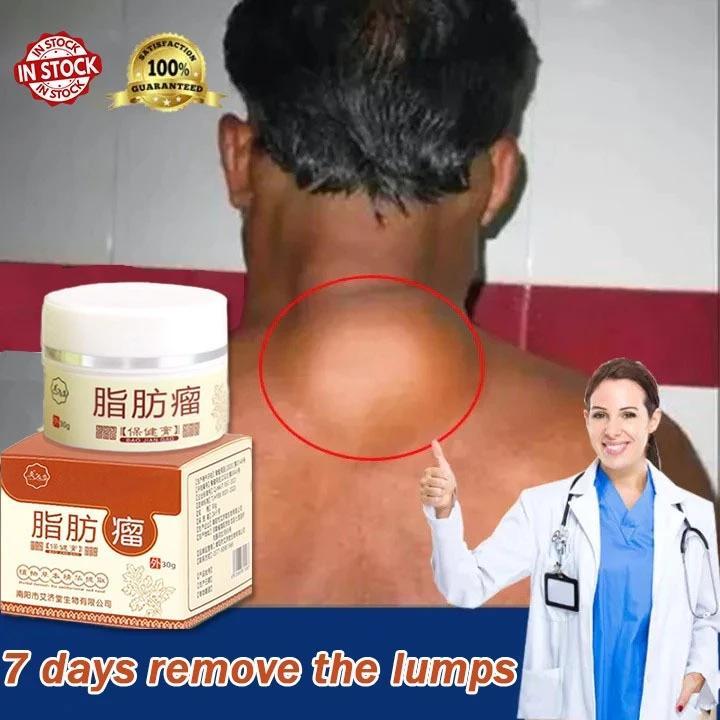 Lipoma Removal Cream Original subcutaneous Lipoma Elimination Fat Lump Lipoma Remover Ointment