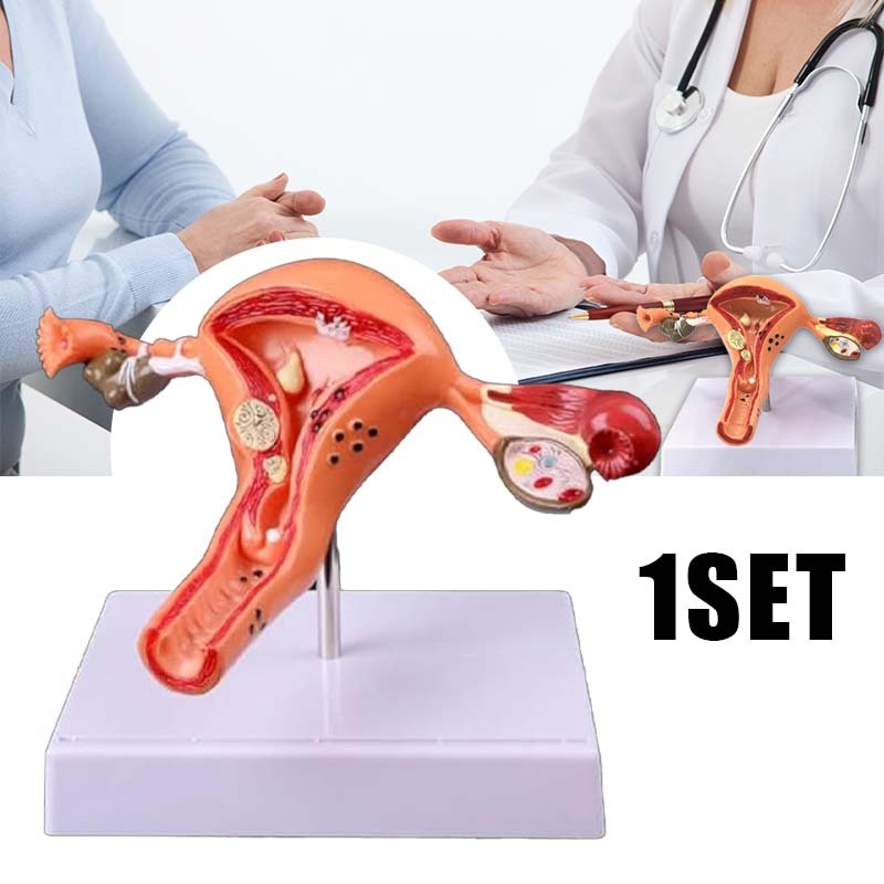 Alat Peraga Uterus Patologis Uterus Ovarium Alat Peraga Uterus Dan Ovarium 1set Uterus Anatomical Mo