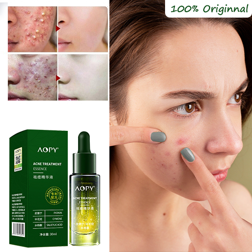 Penghilang jerawat Memudarkan bekas jerawat Herbal Anti-Acne Essence 30ml Krim anti-jerawat yang tid