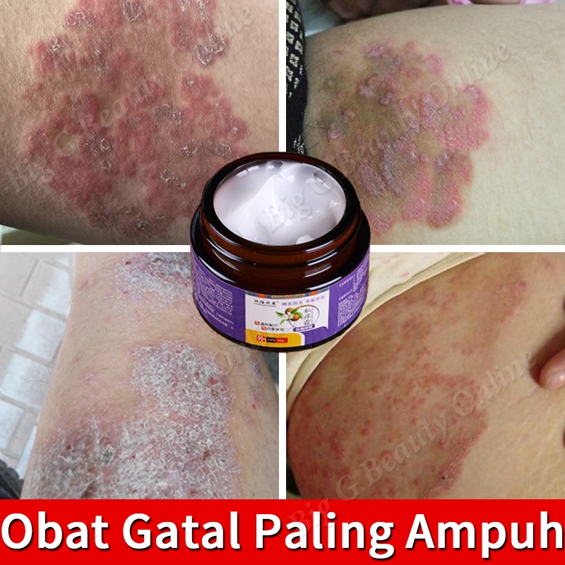 Salep Gatal Selangkangan Anti Jamur Obat Gatal Kelamin Salep Gatal Paling Ampuh Menghambat Dermatiti