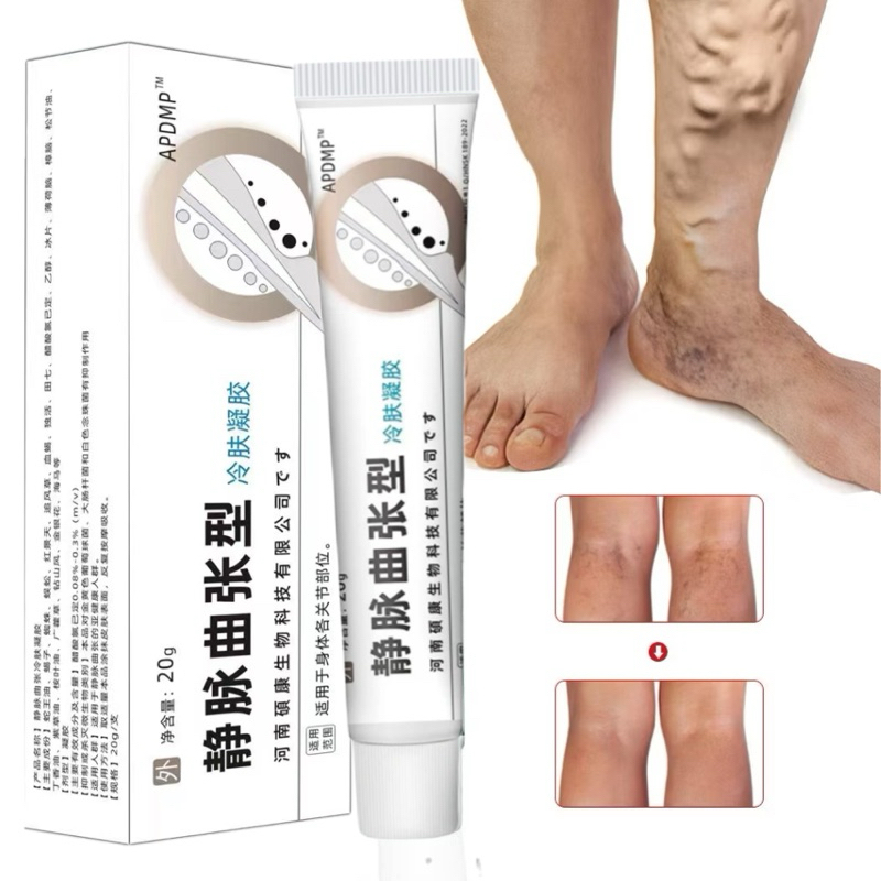 Obat Varises Paling Ampuh, Obat Varises di Betis Kaki, Penghilang Varises, Urat Menonjol, Menghilang