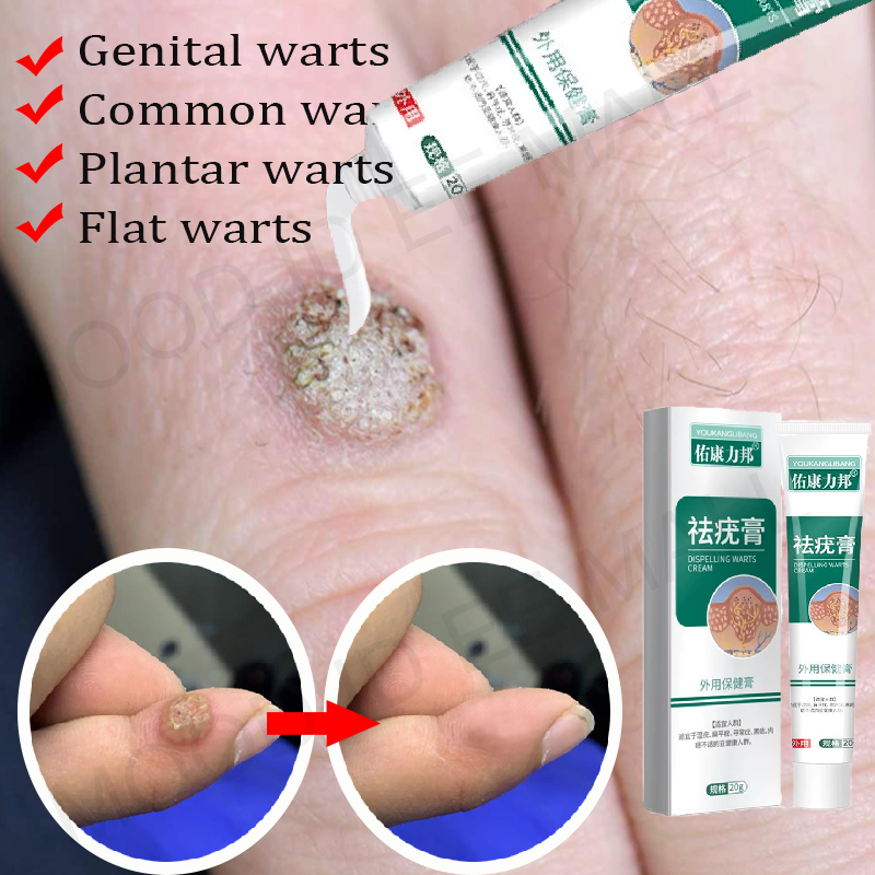 Obat kutil paling ampuh Penghilang kutil dan tahi lalat Plester kutil mata ikan Skin tag remover Pen