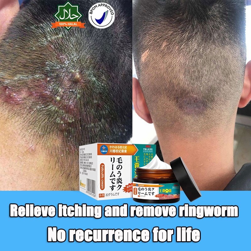 salep pereda sakit kepala krim koreng kepala krim anti gatal 30g Obat psoriasis kulit kepala, obat k