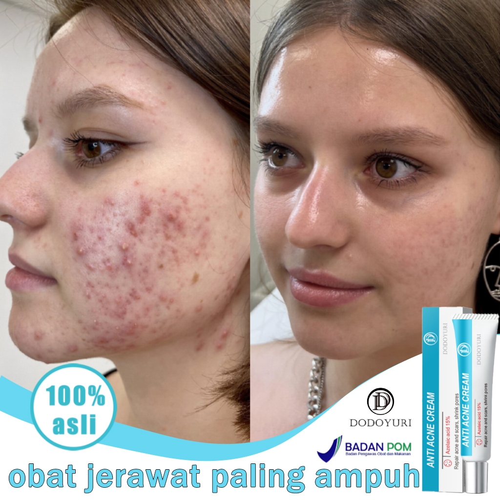 Penghilang bekas jerawat Menghilangkan bekas jerawat Penghilang bekas jerawat hitam 20g Penghilang b